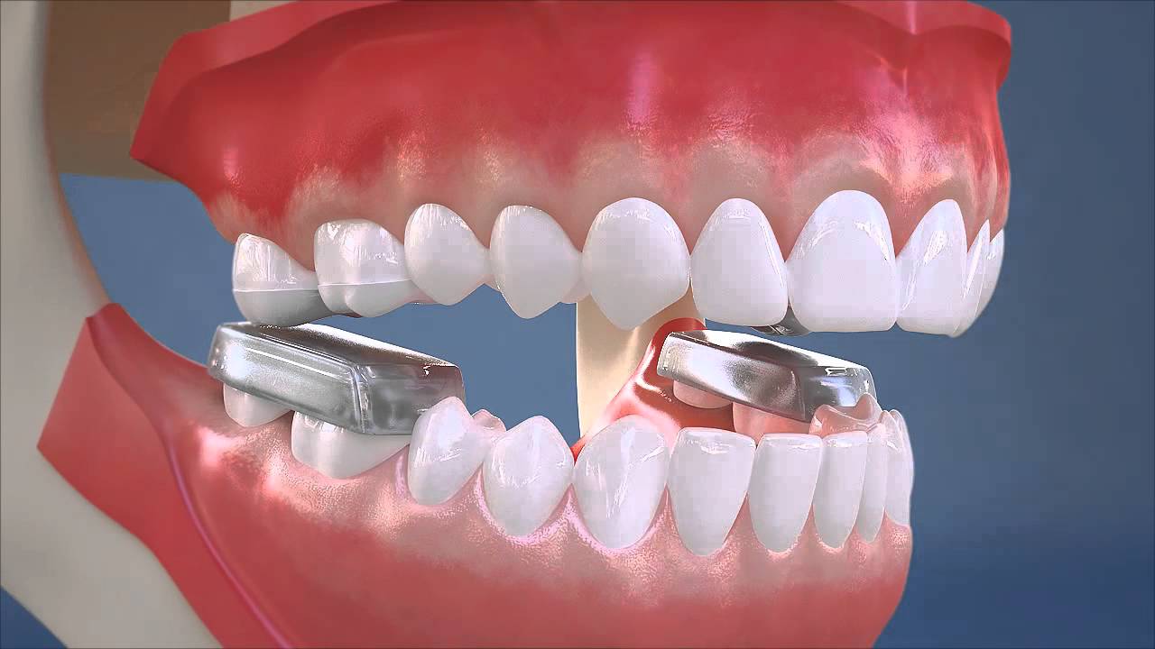 Bite Block
