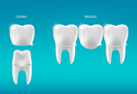 Crowns & Bridges
