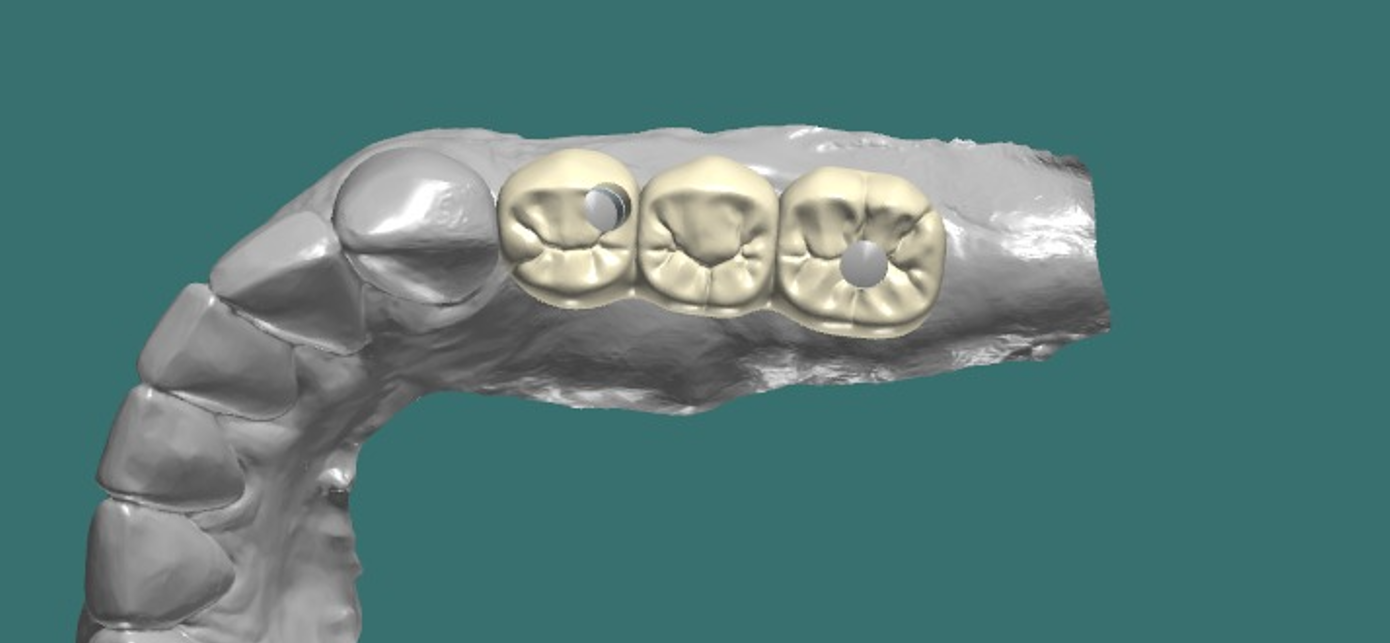 Implant Crown & Bridges