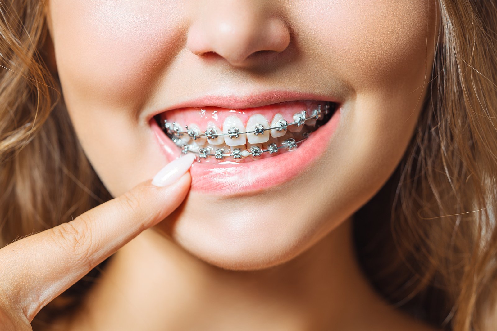 Dental Splint